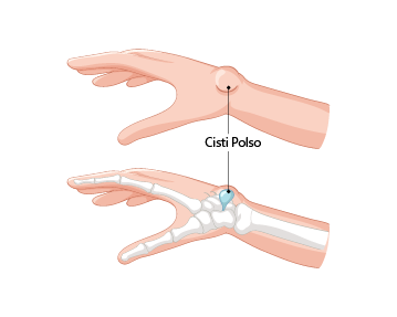Illustrazione della cisti del polso