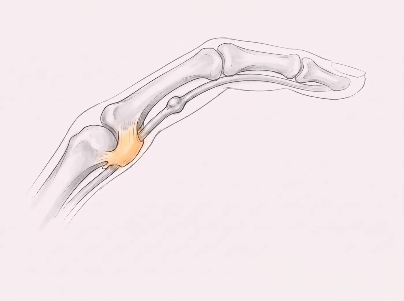 Illustrazione della puleggia A1 ispessita alla base del dito nel dito a scatto