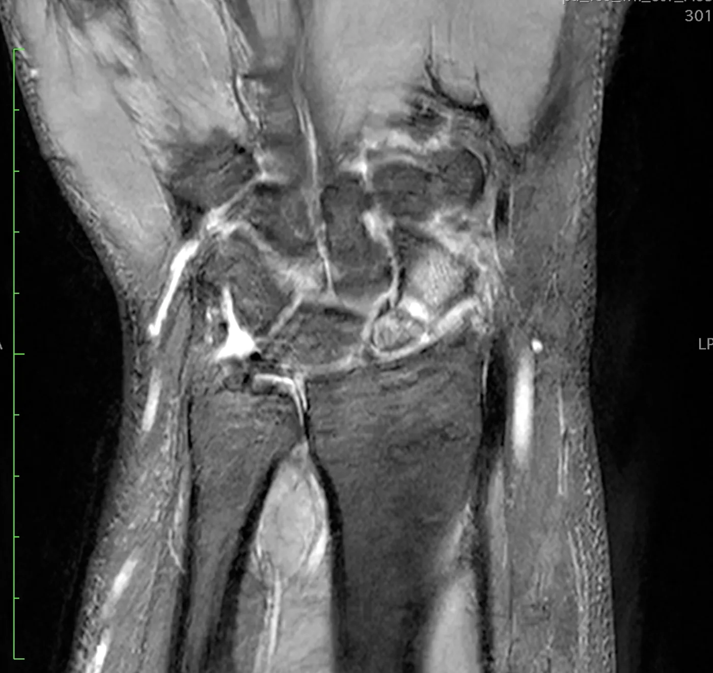 Risonanza magnetica di una pseudoartrosi dello scafoide