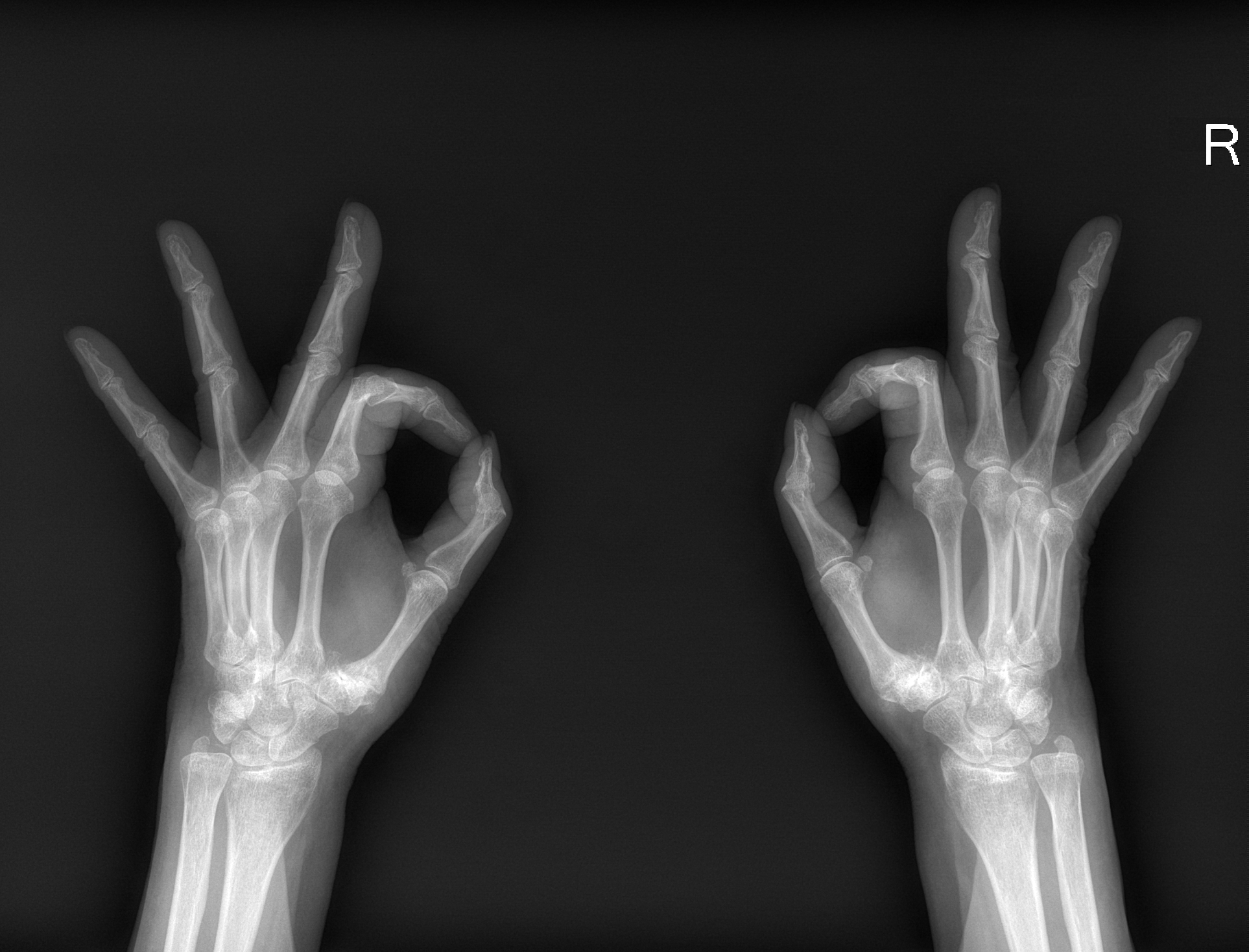 Radiografia di entrambe le mani con le basi dei pollici visibili