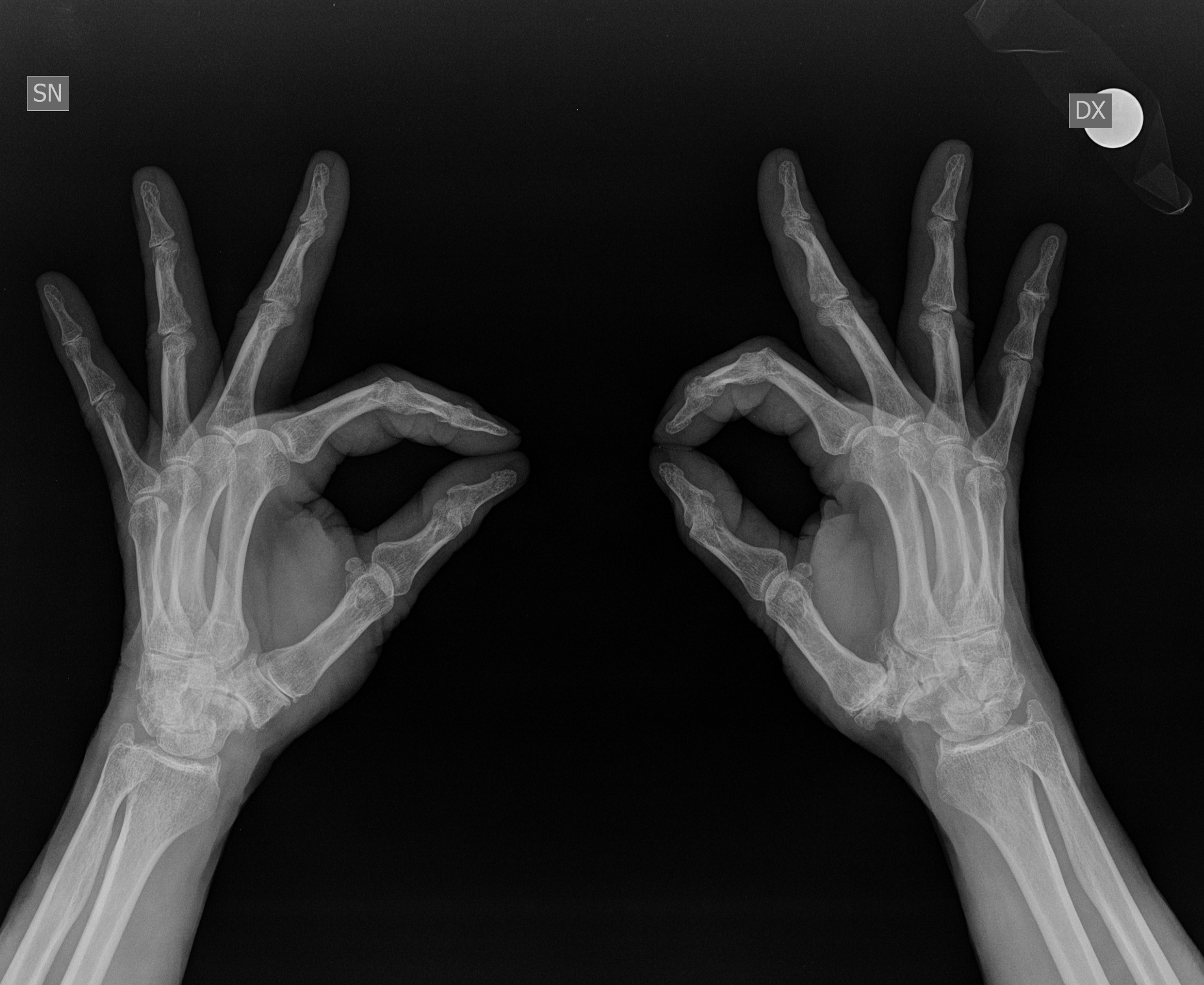 Radiografia dei due pollici con marcatori di destra e sinistra