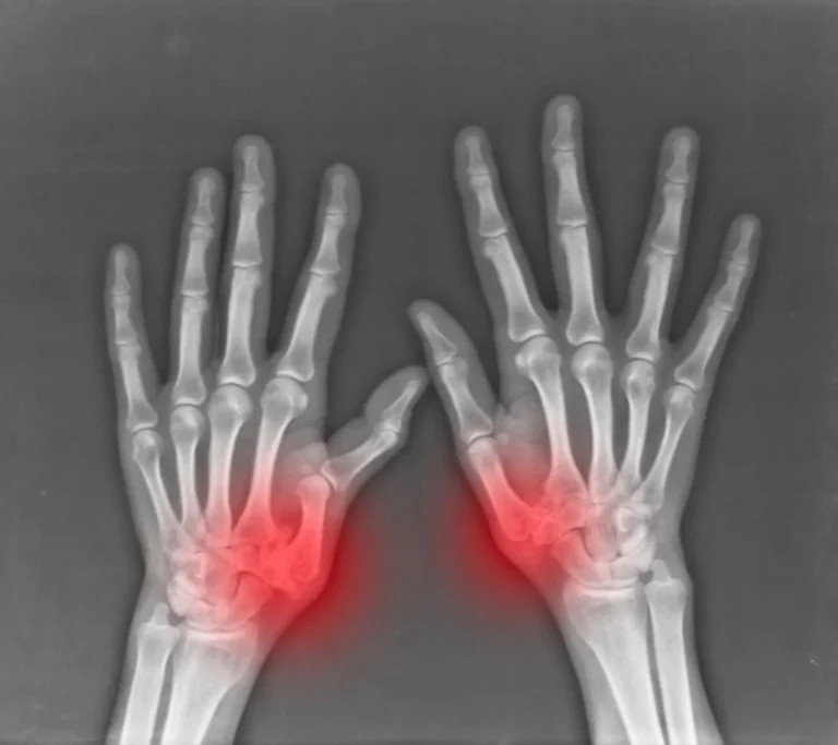 Radiografia delle mani con artrosi alla base del pollice (rizoartrosi)