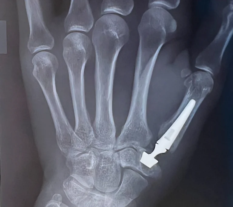 Radiografia della mano con protesi trapezio-metacarpale